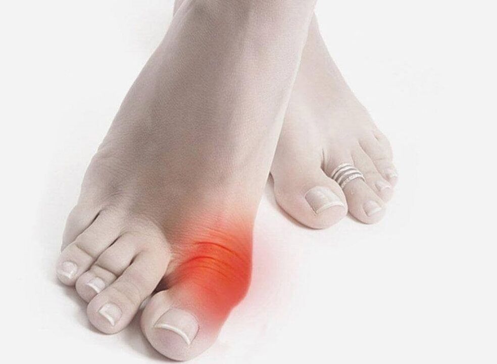 симптомы подагры на ногах